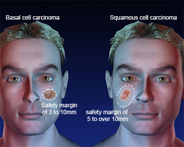 Safety-margins-Skin-Tumors
